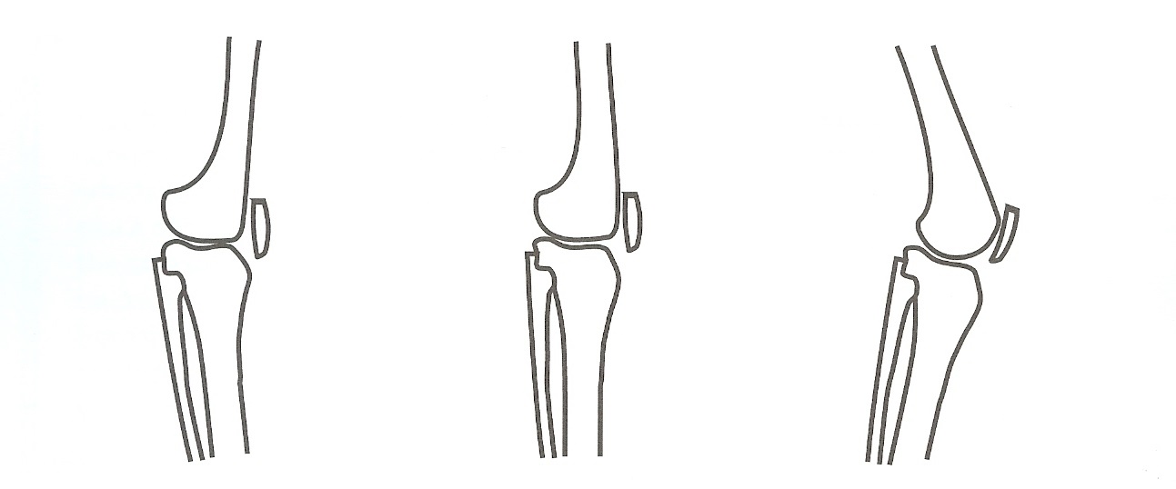 Three ways or organizing your knee joint. In each illustration the front of the leg is toward the right. On the left the knee is locked. In the middle the knee is straight. Notice how the to leg bones balance on top of each other. On the right the knee joint is bent.